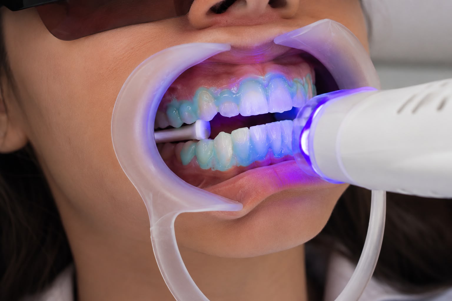 Clareamento dental